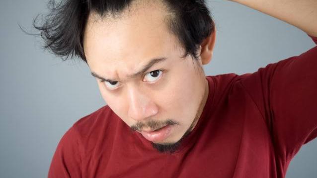 找回頭頂風光　對抗雄禿元凶「DHT」治療攻略