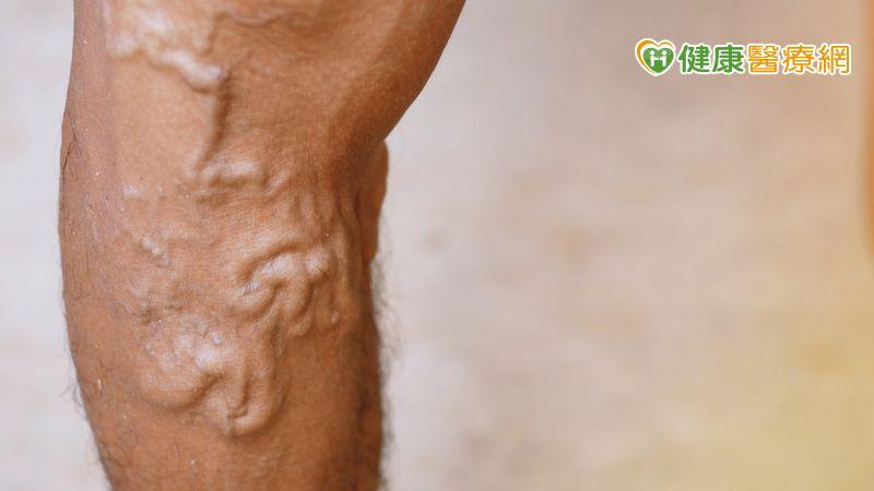 靜脈曲張腫又痛行唔到　封靜脈血管改善症狀