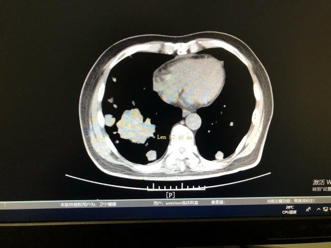浙江婦抗癌8年家人不離不棄　殘疾夫及奶奶打工籌醫藥費