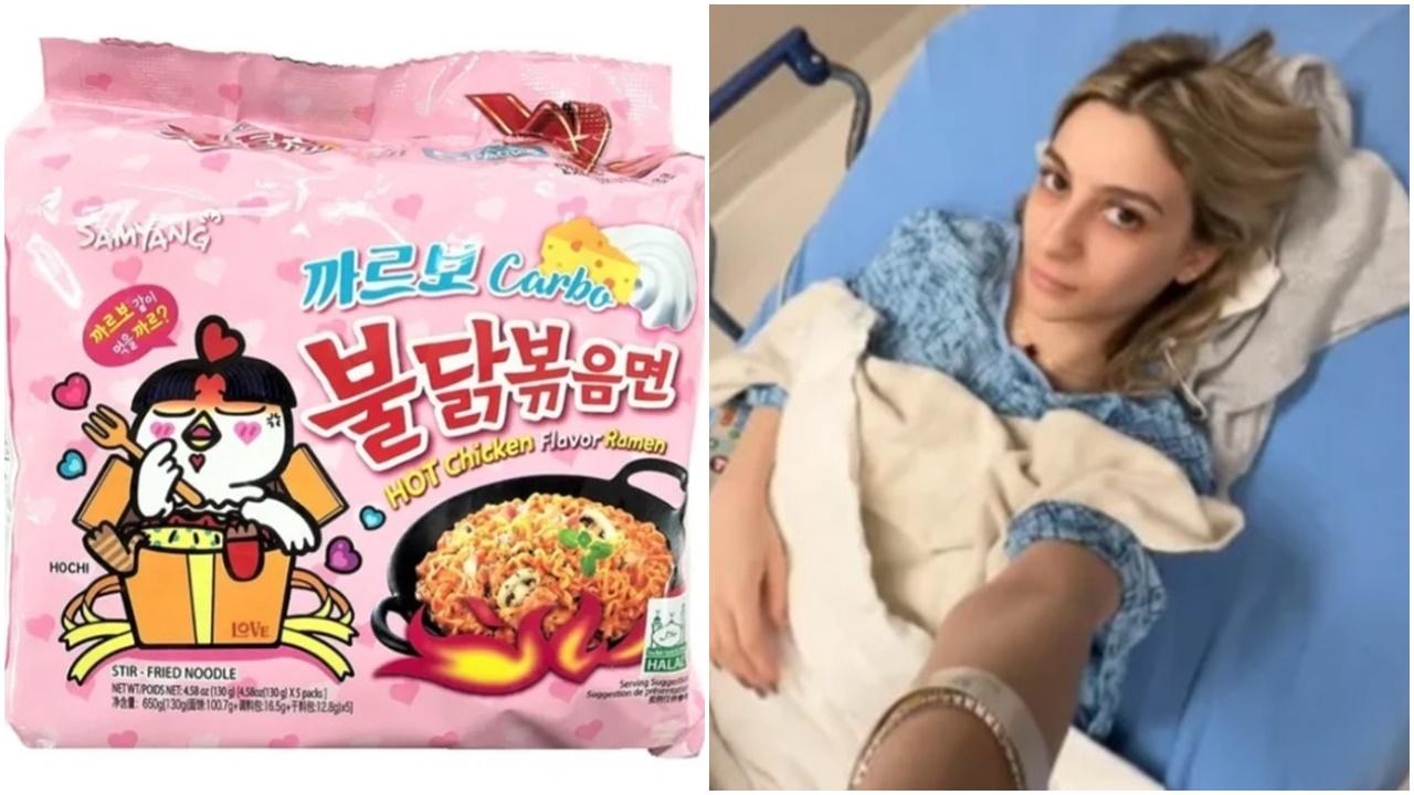 美網紅連食6個月韓式麵屙血尿入院，醫生警告高鹽可致敗血症。