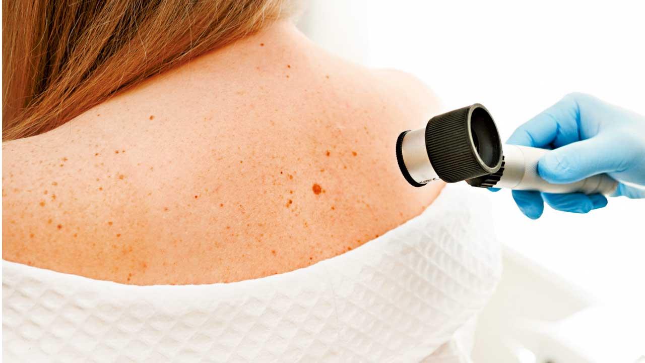 皮膚突現異樣或是皮膚癌！