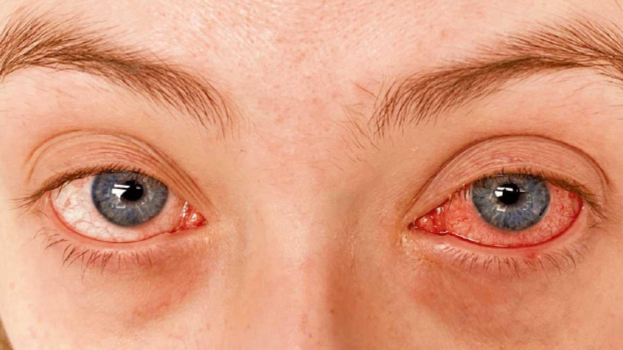 紅眼症可大可小 虹膜炎的診斷和治療