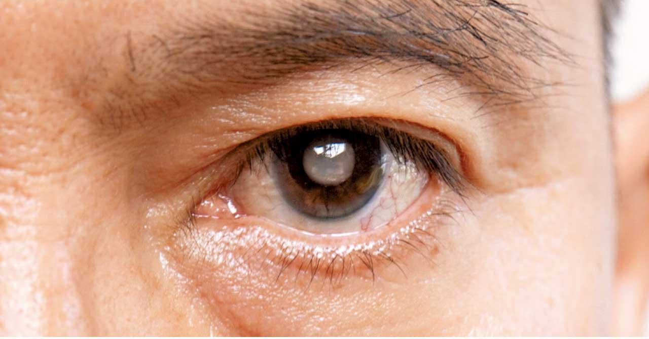 新式微創手術治療青光眼供病人選擇