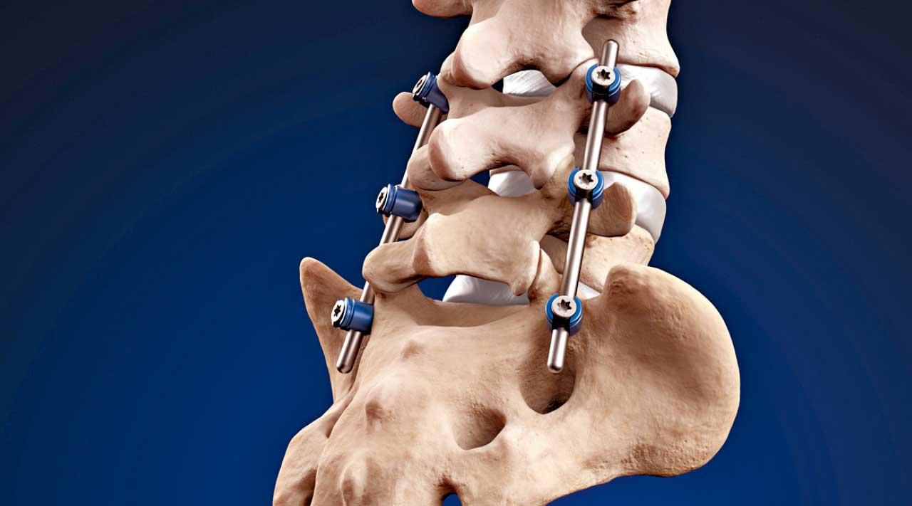 機械臂做脊椎手術 增精準度安全性