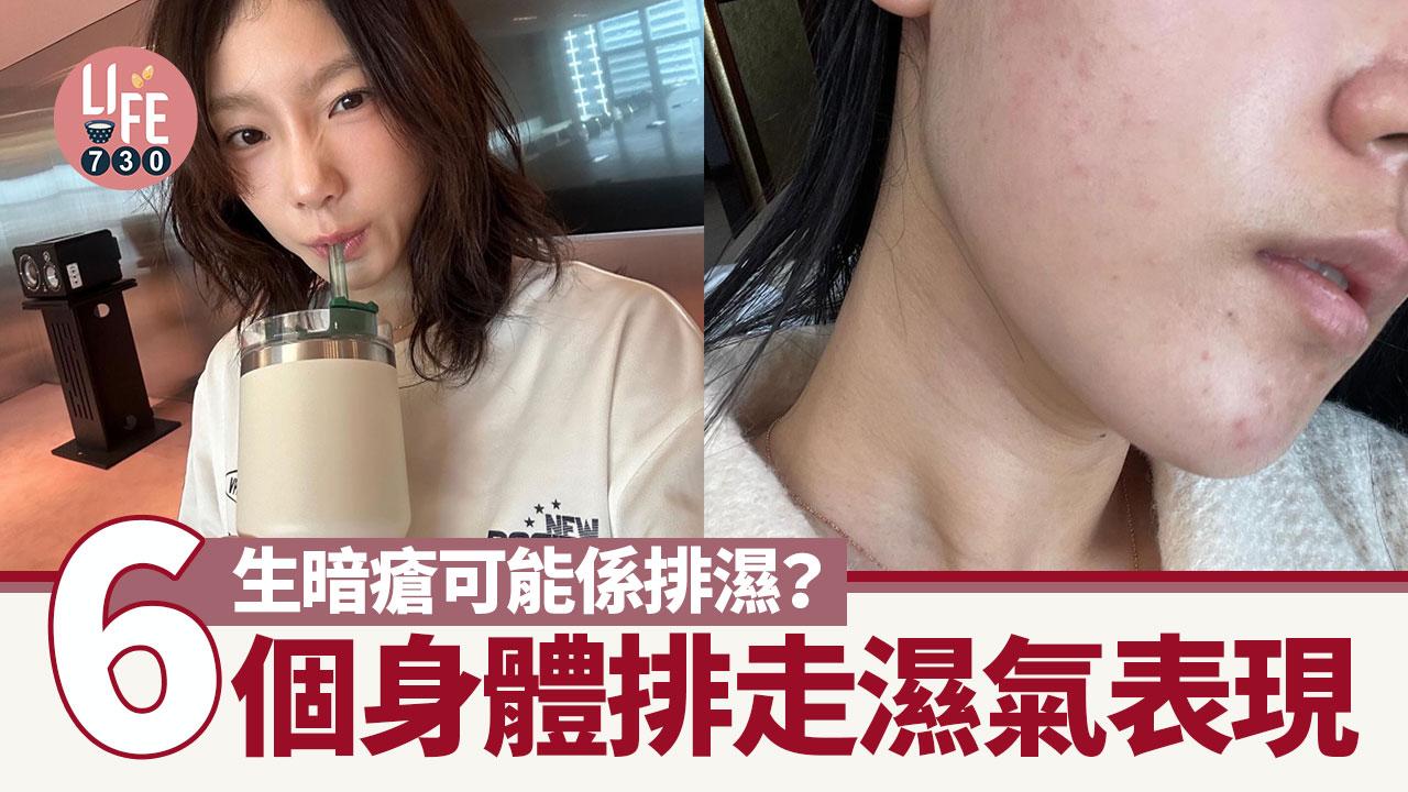 潮濕｜生暗瘡可能係排濕？　6個身體排走濕氣表現