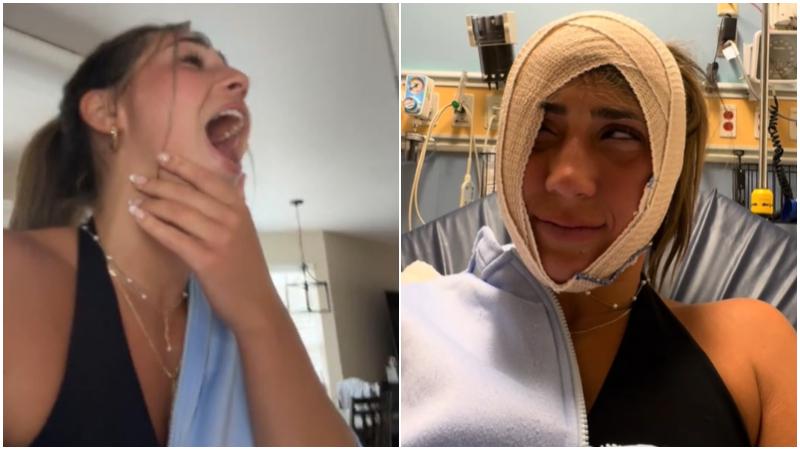 美國女打喊露出事「合唔到嘴」　下巴甩骹急求醫