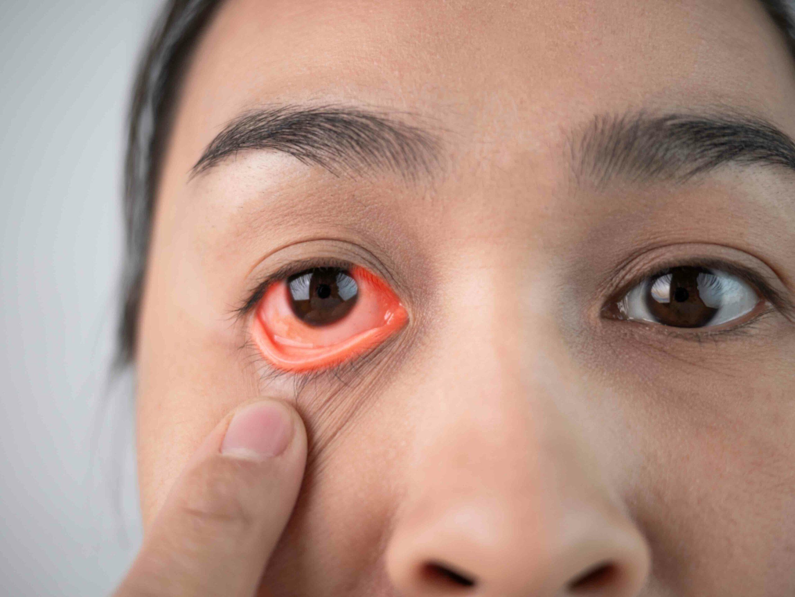 眼窩蜂窩組織炎