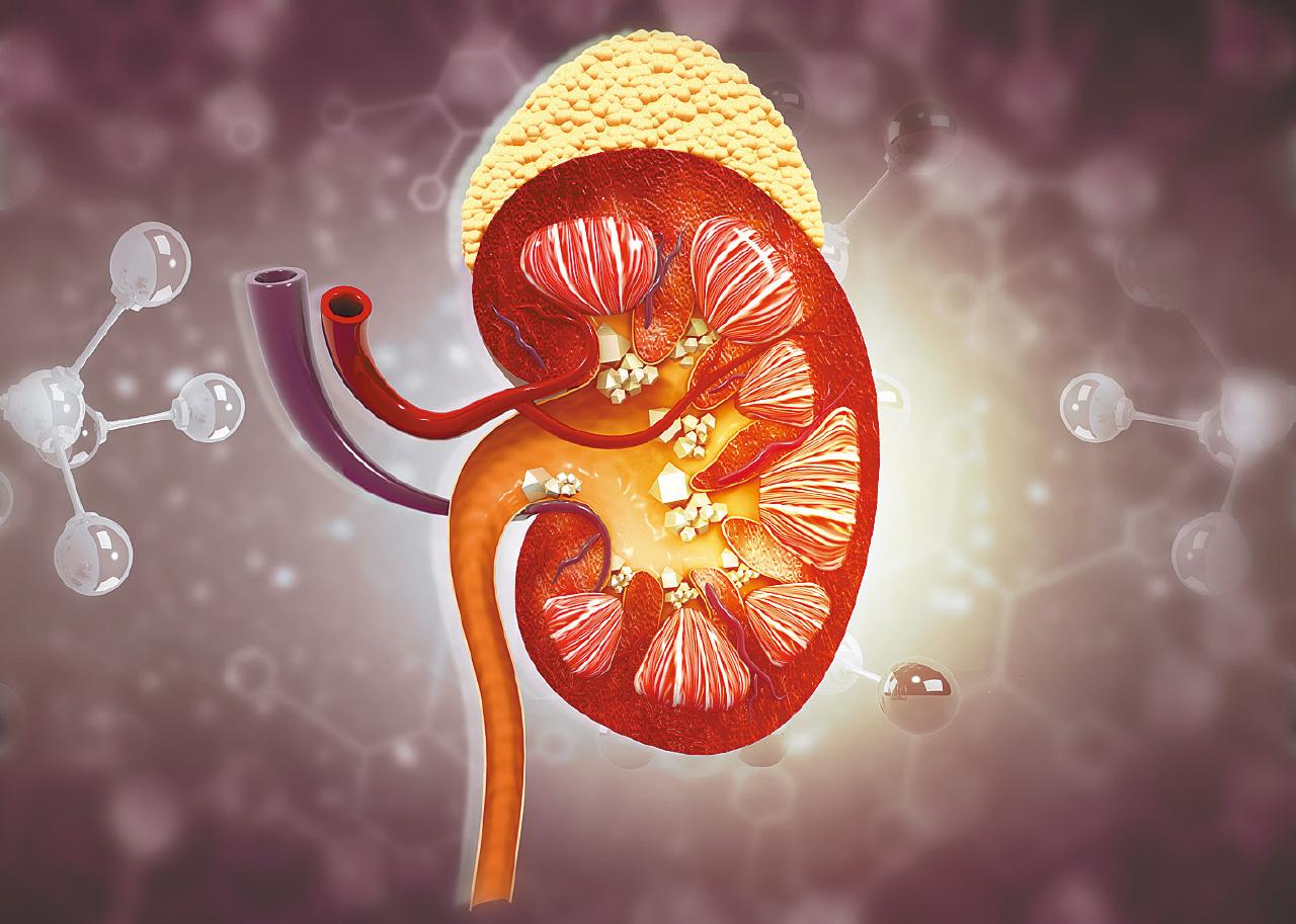 腎石幾時要處理？