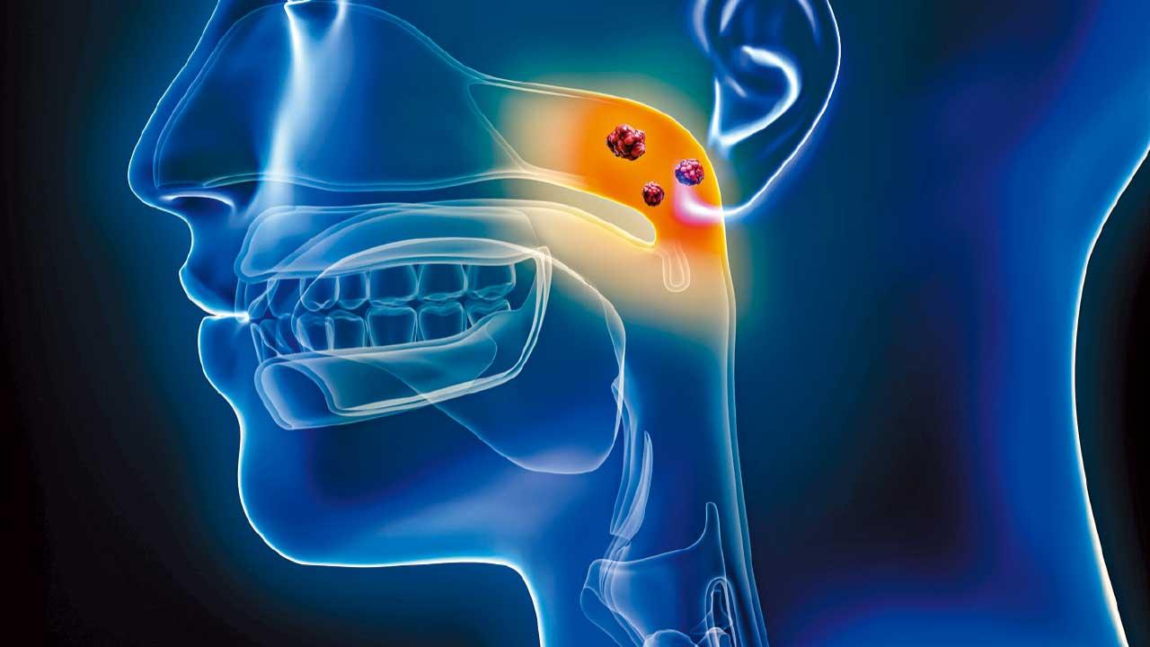 中大新藥 針對EB病毒 治療鼻咽癌