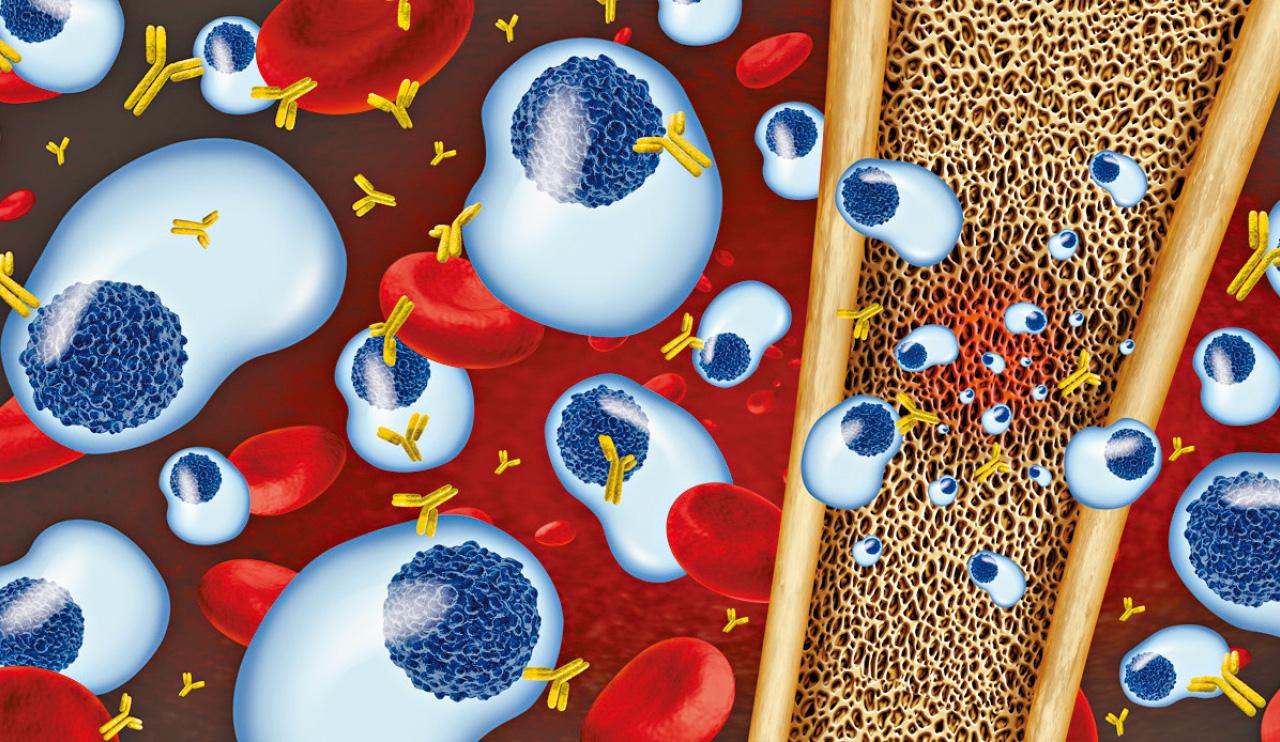 多發性骨髓瘤 治療或成經濟負擔