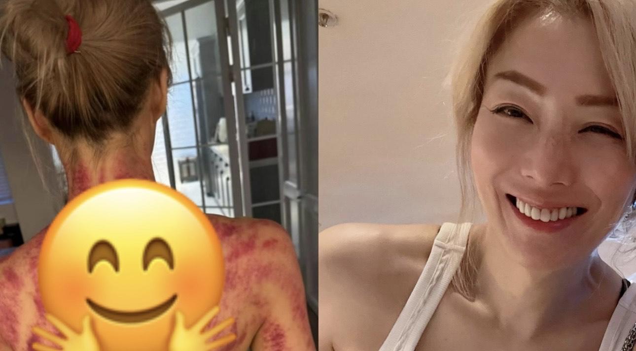 51歲鄭秀文半裸曬背 刮痧血紅痕跡嚇窒網民