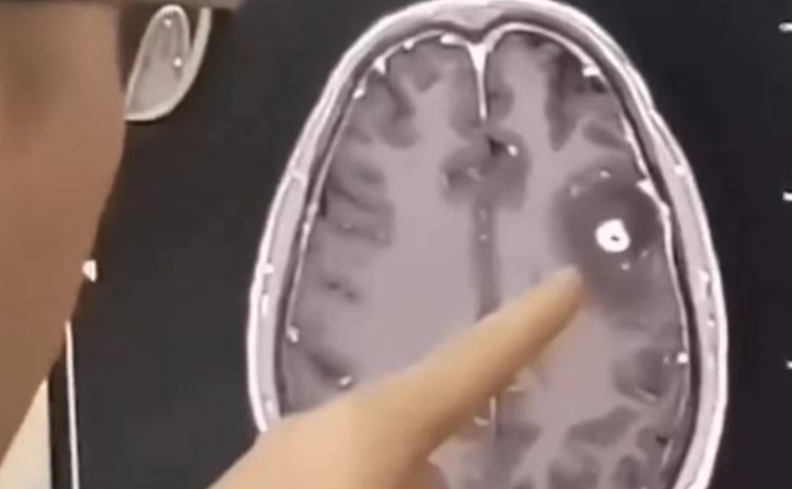 深圳一名62歲男子近日在家中暈倒，經醫院檢查發現，其腦內被寄生蟲感染。經過三次驅蟲治療，他顱內寄生蟲大減，病情逐漸好轉(影片截圖)