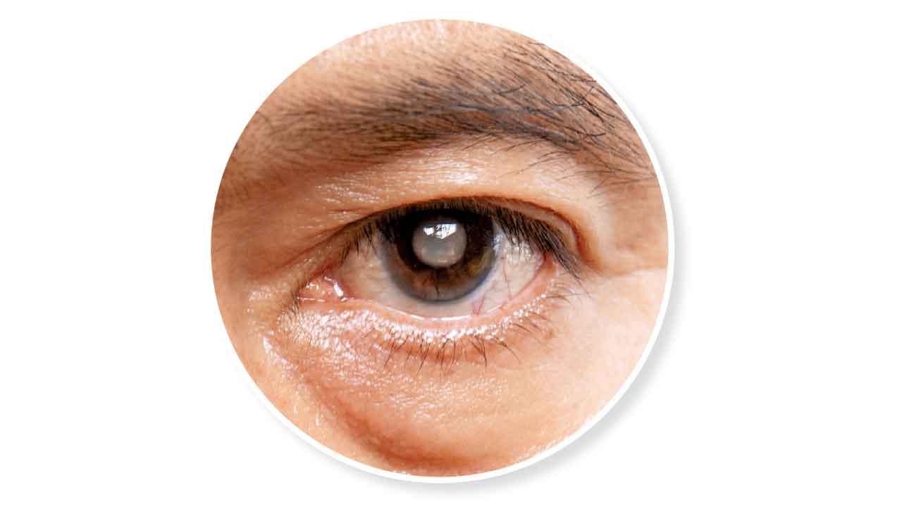 矯視前數據 增白內障手術準繩度