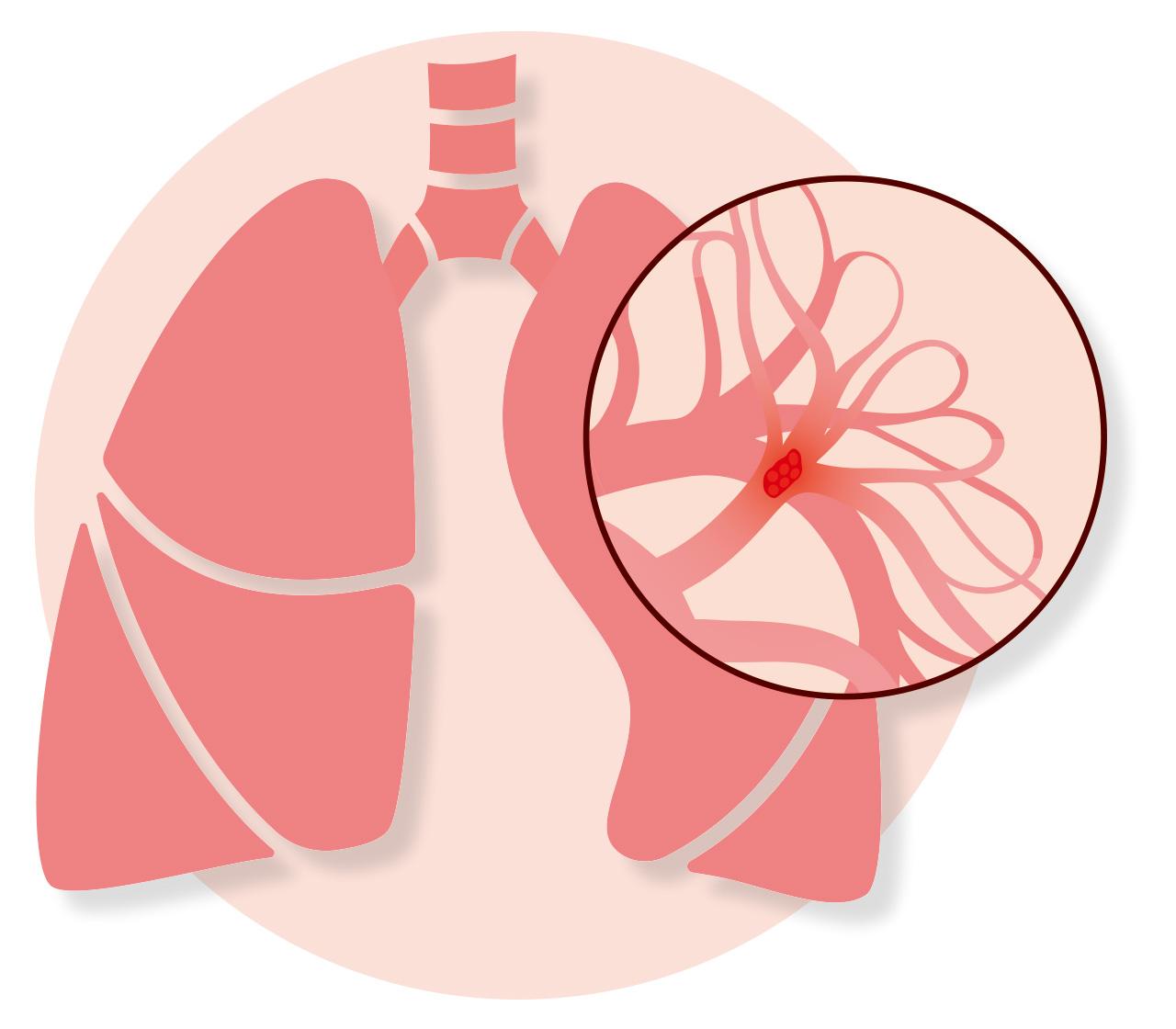 肺動脈栓塞 可致右心衰竭