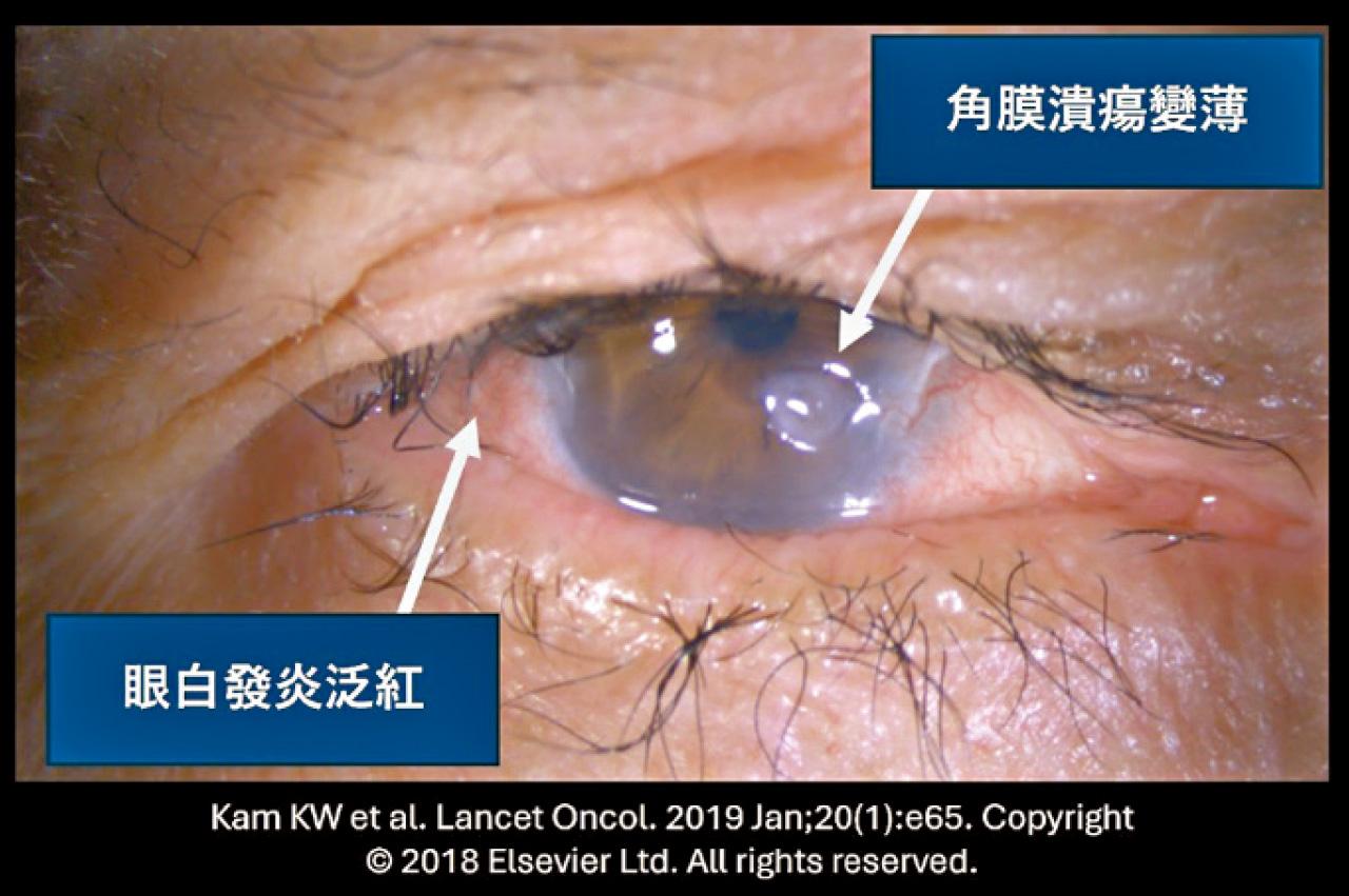 眼睛生命二選一