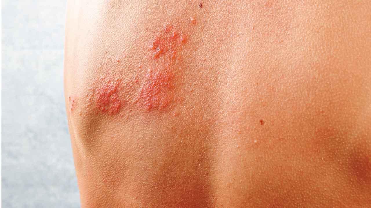 痛楚可持續一年 生過水痘就可能生蛇