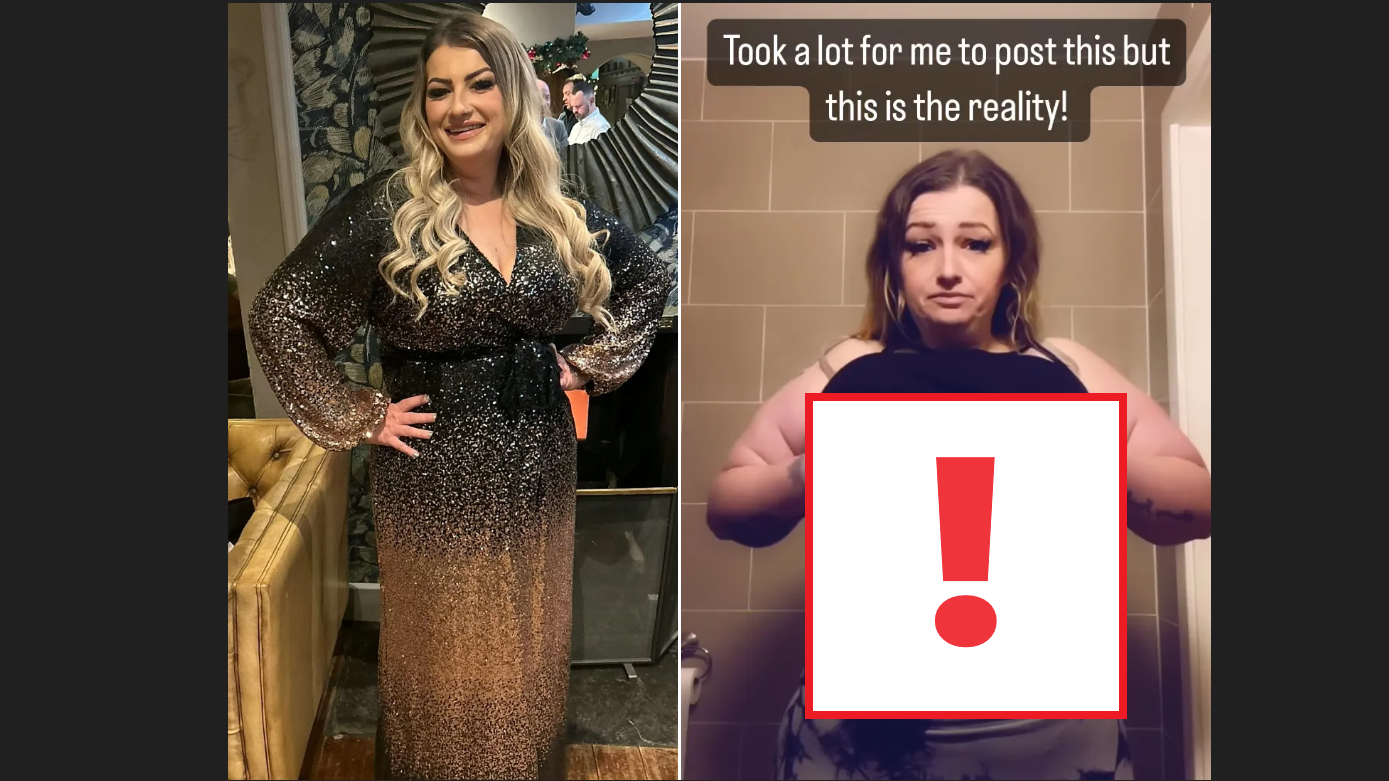 33歲減肥婦做肚腩拉皮手術 中途痛醒叫醫生「殺咗了我」聽到皮膚如烤肉炙燒聲