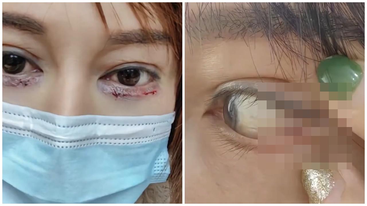 整容意外，內地女花3萬割雙眼皮，眼球眼角竟被縫在一起。(微博)