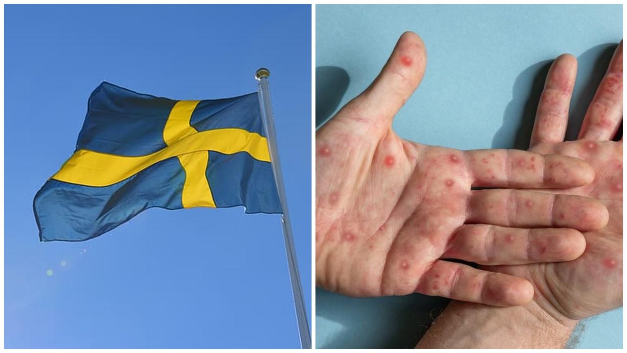 瑞典錄一宗新變種猴痘個案，為非洲以外首例。