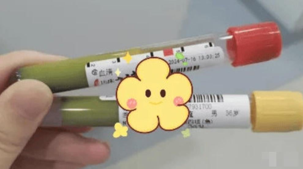 36歲男抽出駭人奶綠色血液，檢出4病症須洗血救命。(微博)