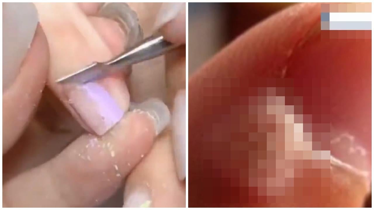 武漢女頻密美甲生肉粒，檢查驚揭感染HPV。(微博)