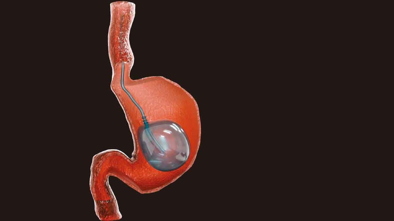 控制飲食、運動減肥無效 可考慮胃水球