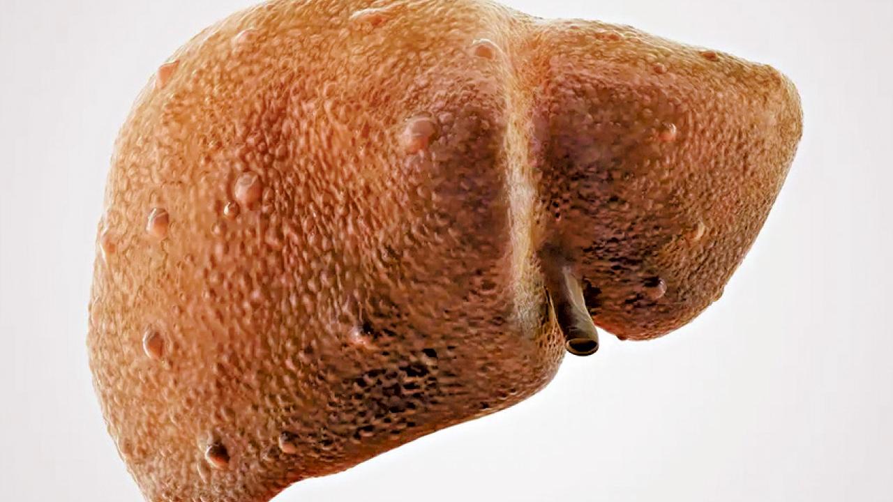 氣泡治肝纖維化比治肝癌更不可思議？