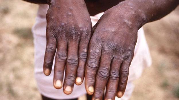 世衞宣布猴痘爆發為國際關注的突發公共衞生事件。