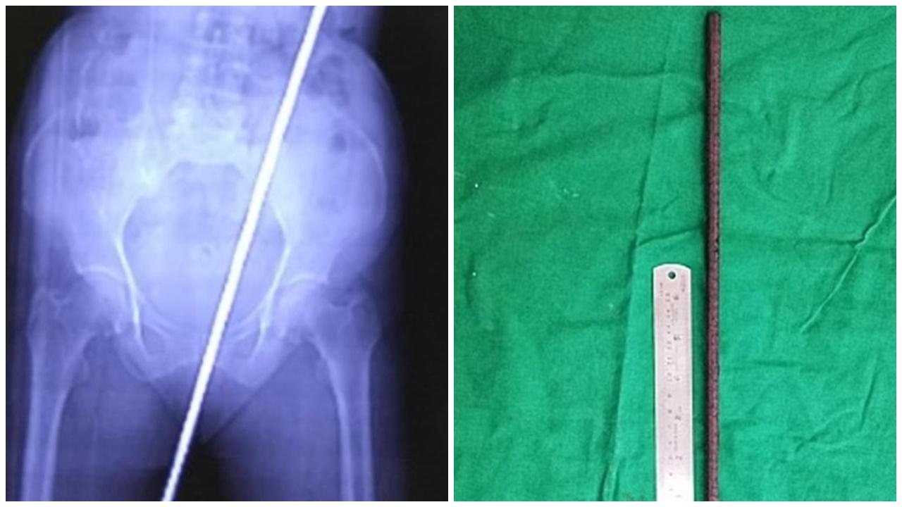 婦人一跌慘被2呎長鐵棍貫「後門」，牛屎鐵鏽入肚。(網上圖片)