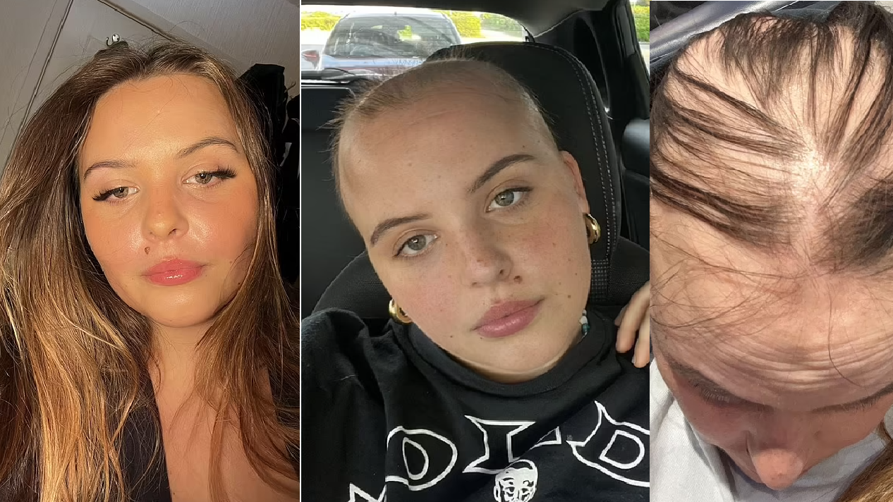 23歲女「中8次新冠」頭髮幾近掉光超慘｜新冠後遺症｜長新冠