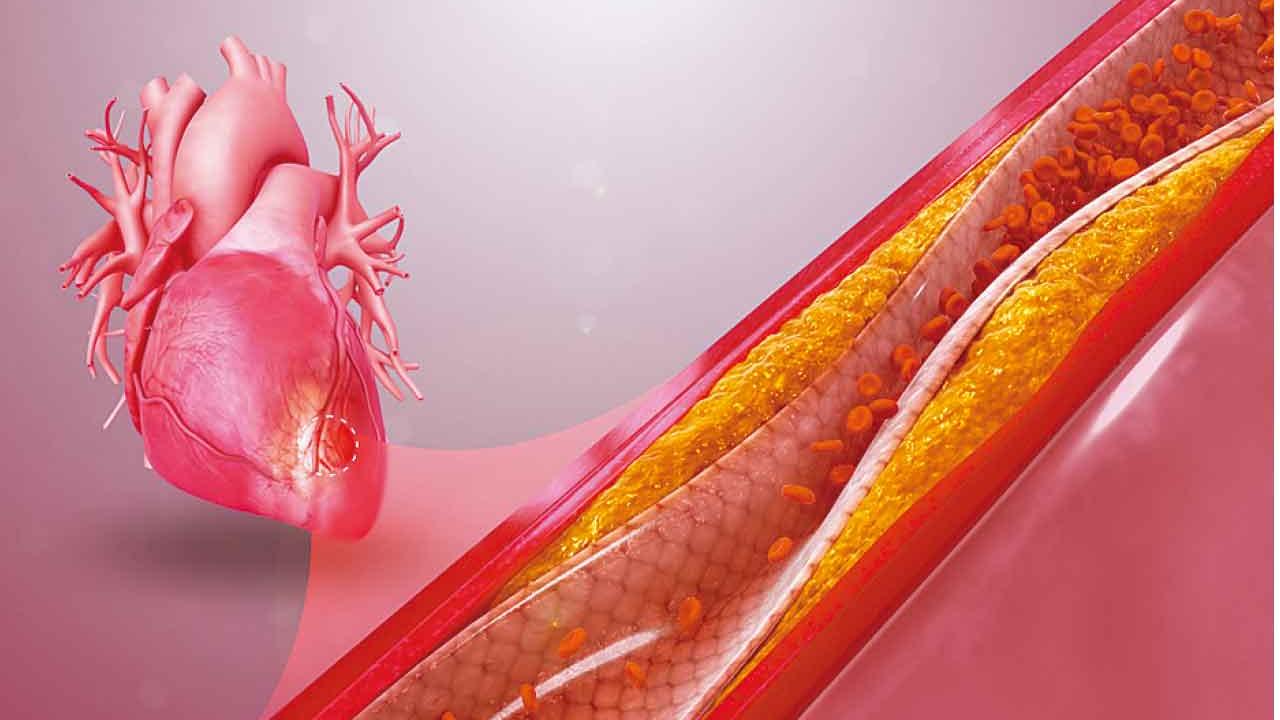 本港主要殺手之一 冠心病成因、治療及研究