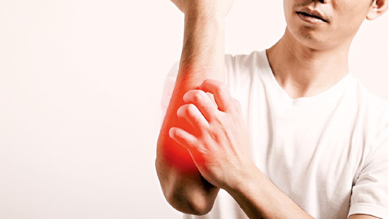 抑制TYK2激酶 針對性改善銀屑病