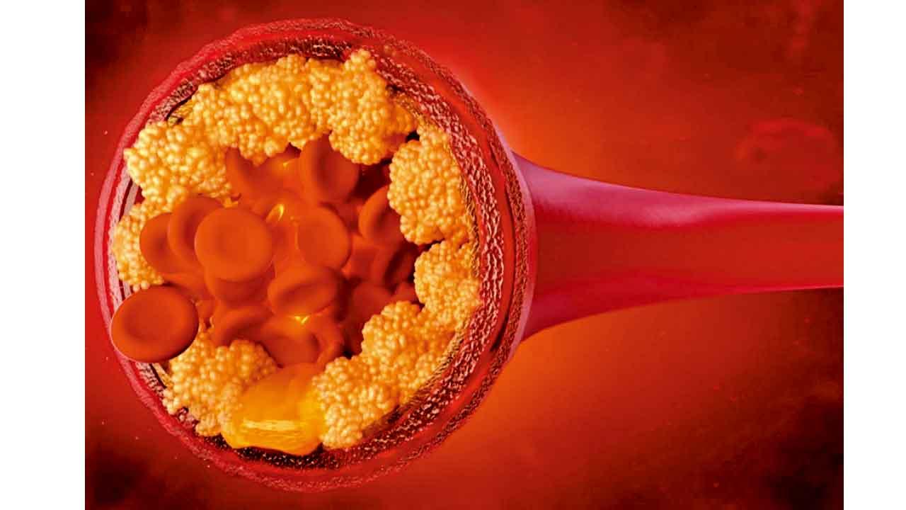 關心你的壞膽固醇(一)