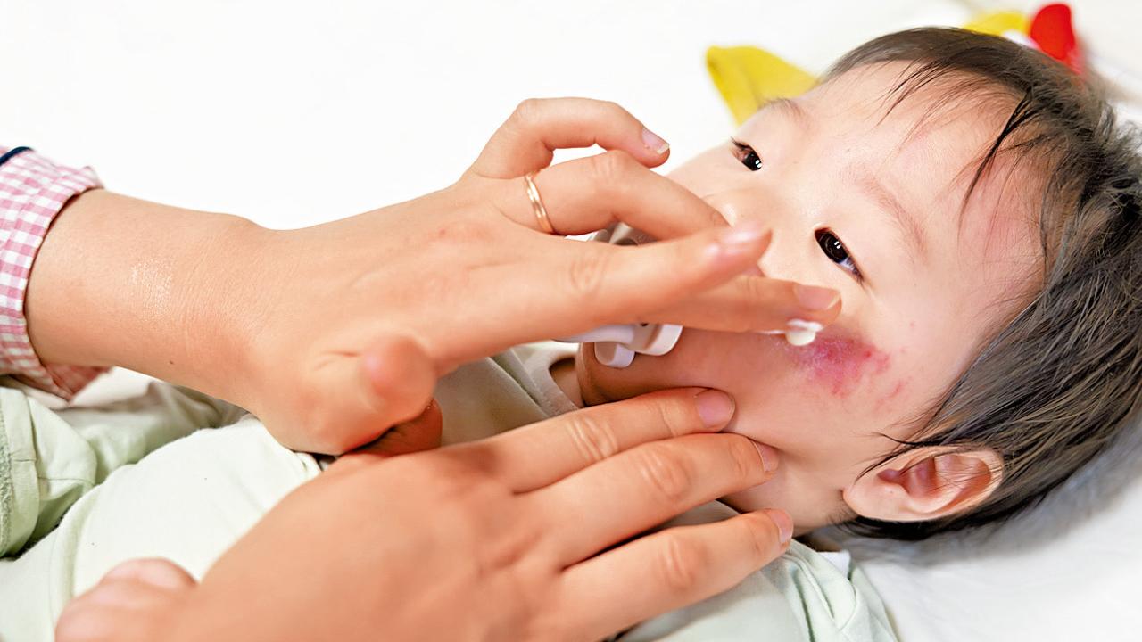 不只皮膚問題 冀多支援濕疹家庭