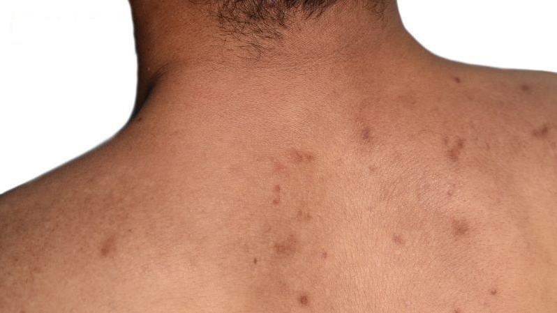 皮膚系統性漿細胞增生症