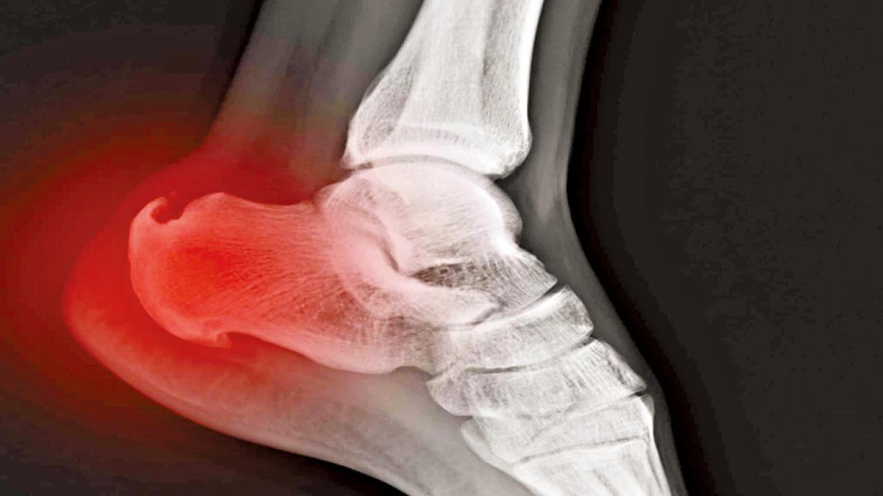 骨刺會導致痛症？