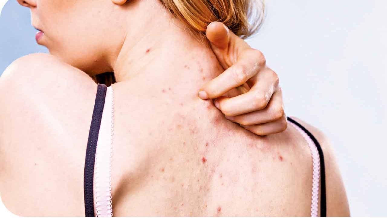 背部暗瘡難斷尾 不處理或留疤變黑