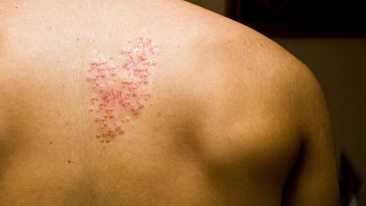 生蛇後遺痛 絲瓜木耳瘦肉湯