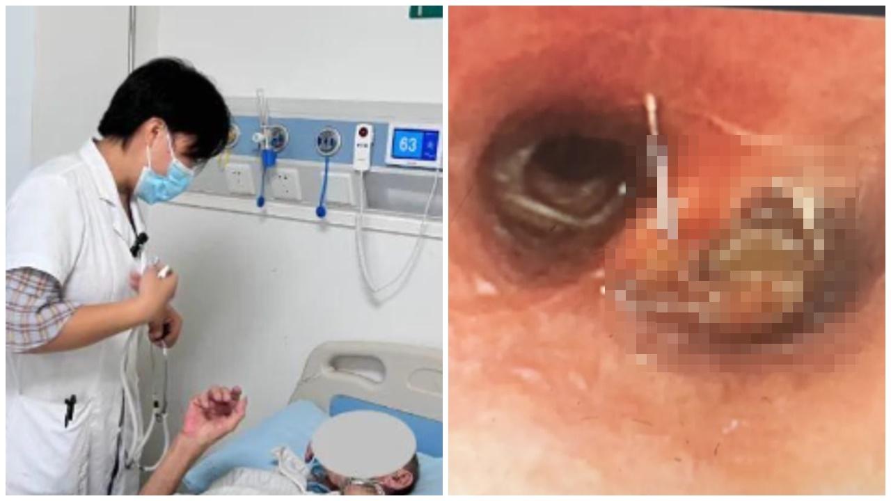 海南漢持續口臭咳嗽吐黃痰，竟因小強卡支氣管。(微博)