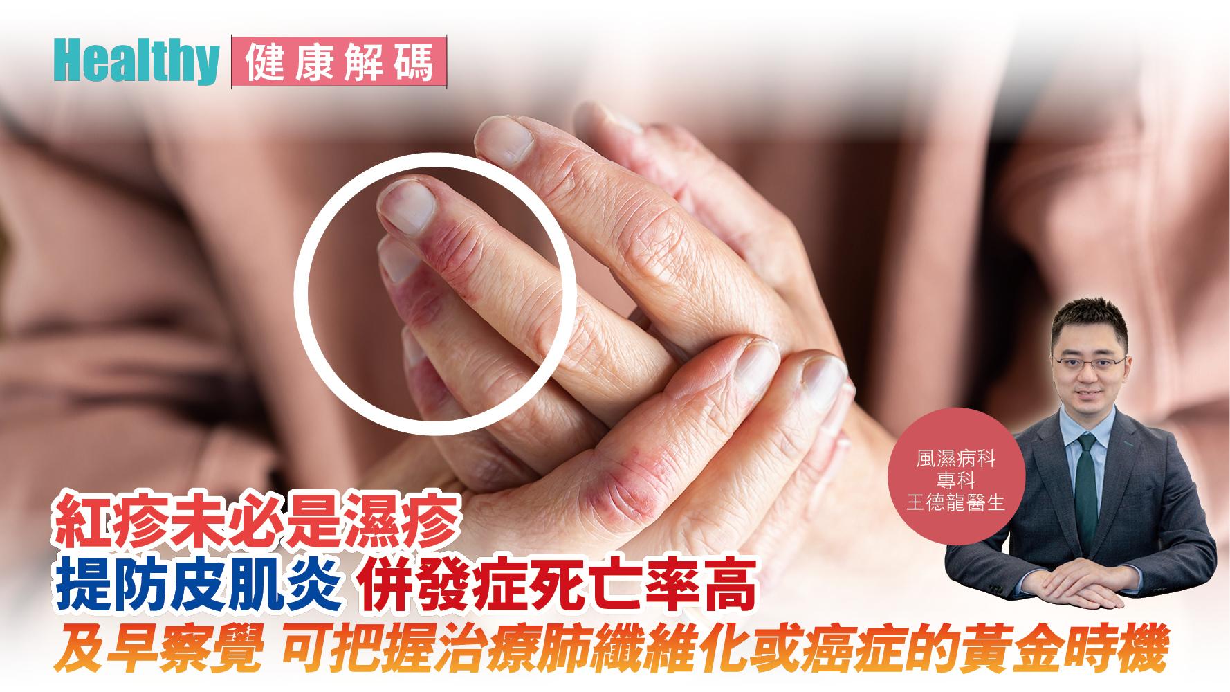 健康解碼｜紅疹未必是濕疹 提防皮肌炎 併發症死亡率高 及早察覺 可把握治療肺纖維化或癌症的黃金時機