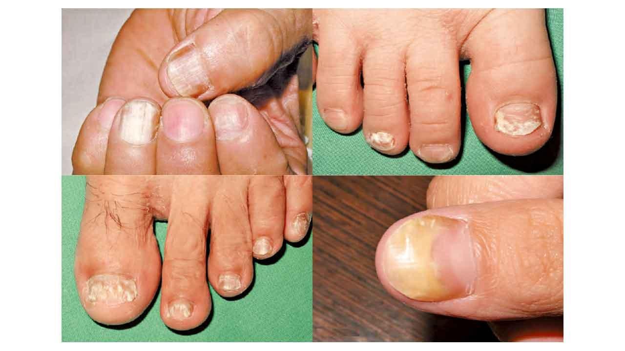 甚麼是指甲真菌(灰甲)?