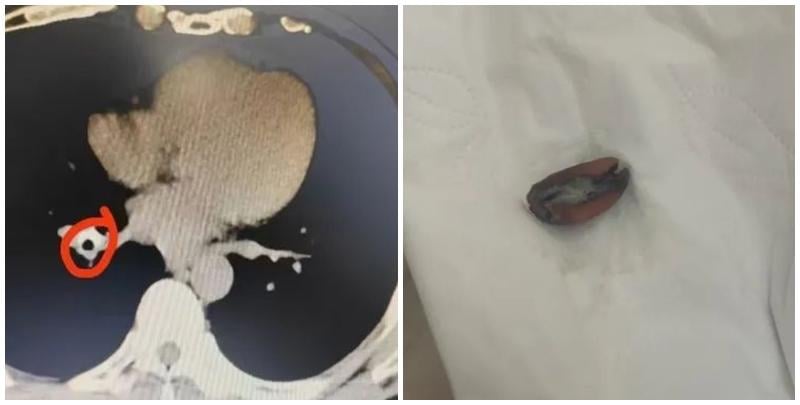 東莞一名男子近年出現反覆胸悶，經檢查發現肺部氣管有異物，取出後竟是半粒花生，原來是他9年前食花生時嗆咳「卡肺」引致。(網上圖片)