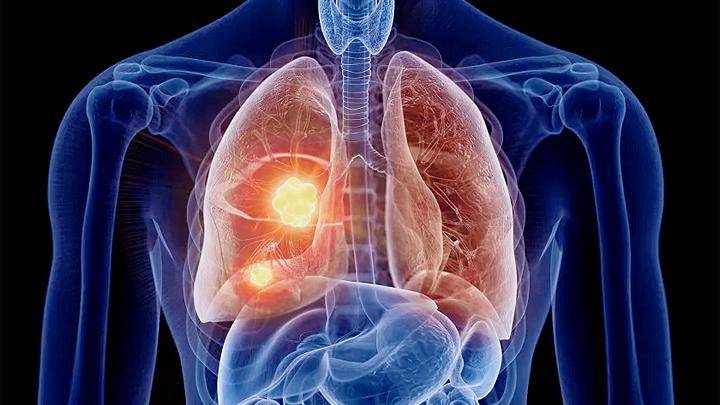 肺癌