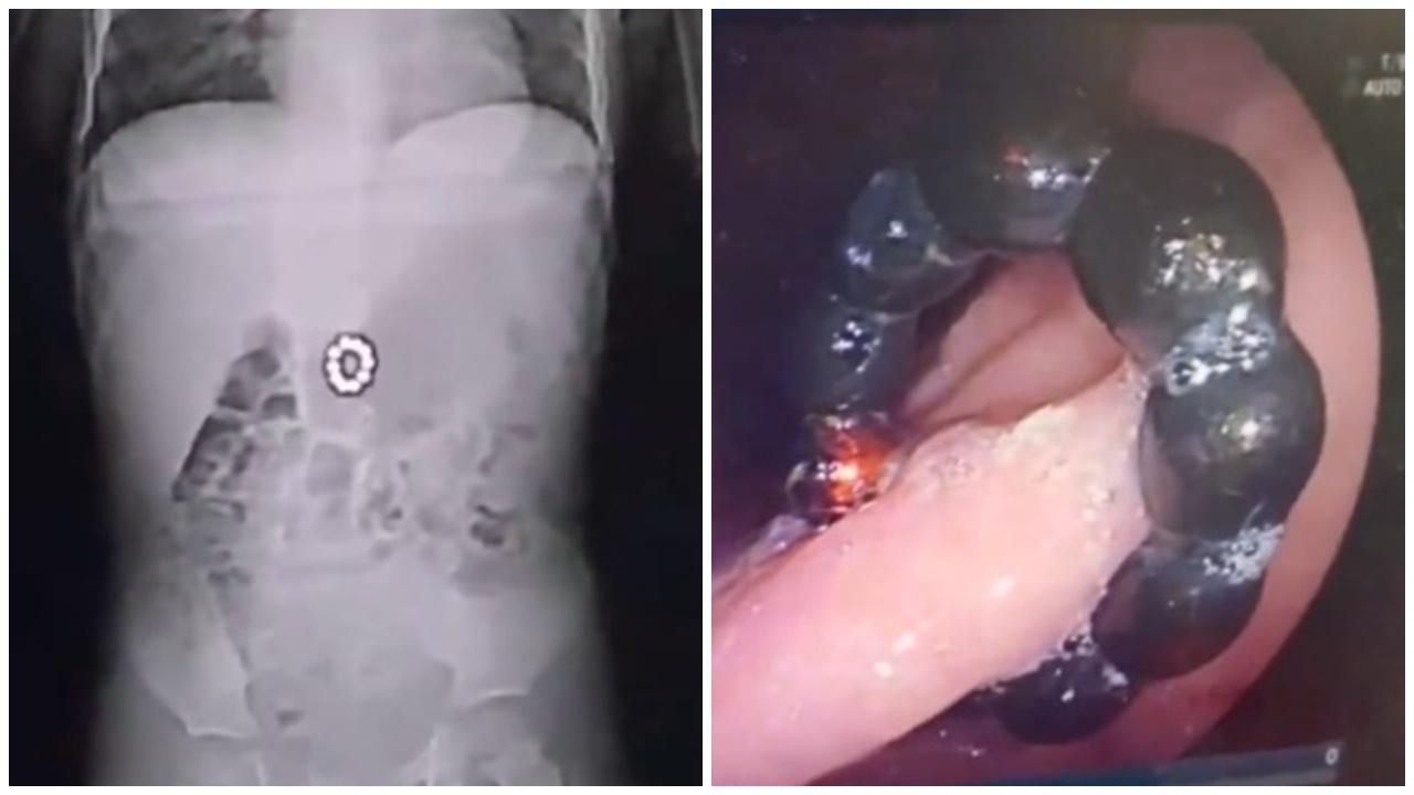 山東4歲童車禍後照CT，驚見1年前吞下磁力珠已致胃穿窿。(微博)