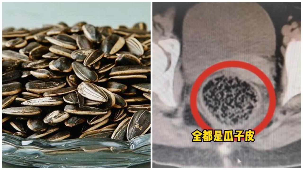 女童食瓜子無吐殼致直腸塞死，醫生清腸臭氣沖天。