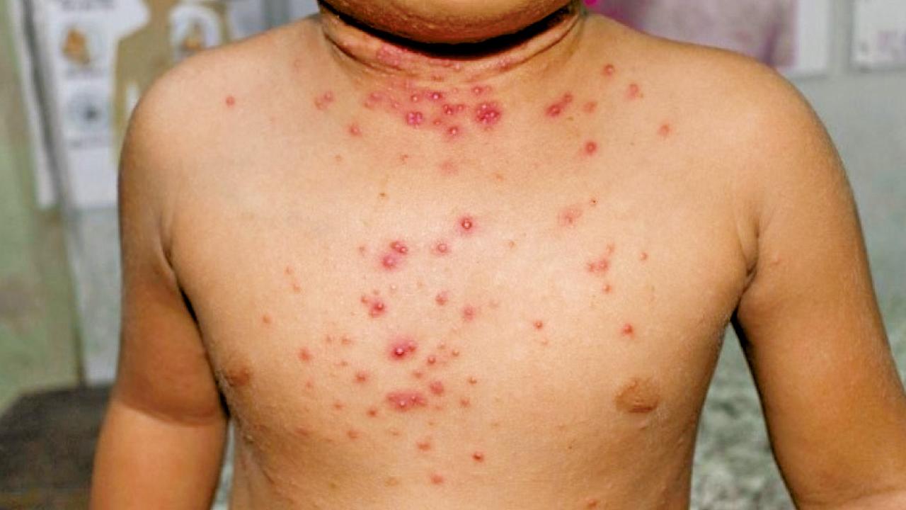 香港兒童也可能感染猴痘？