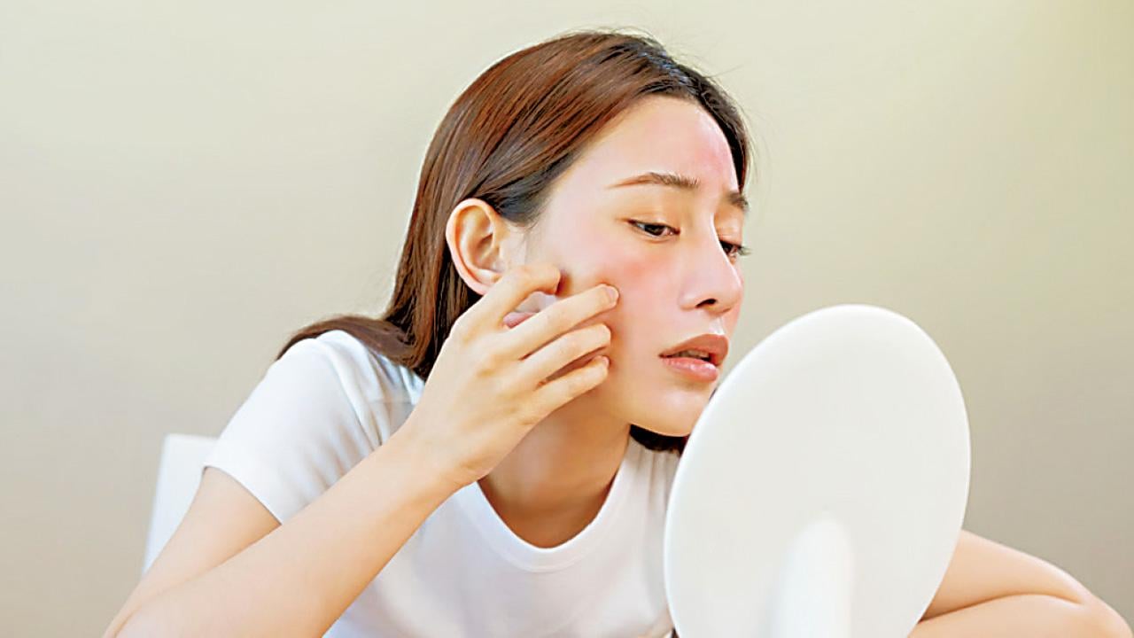 紅斑狼瘡 類固醇的利與弊