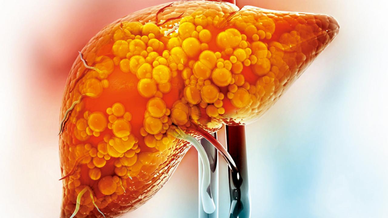 全球最常見的都市病—代謝性脂肪肝