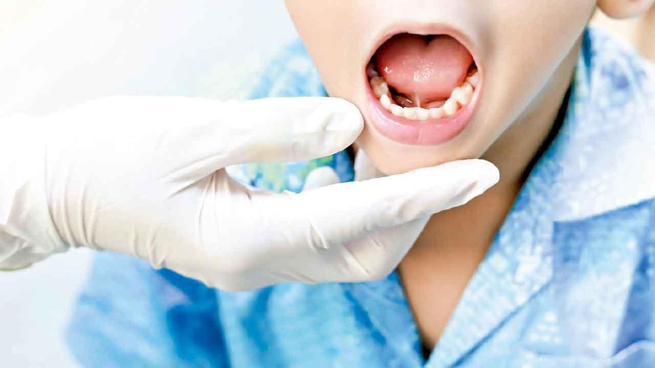 黐脷筋一定要剪脷筋？