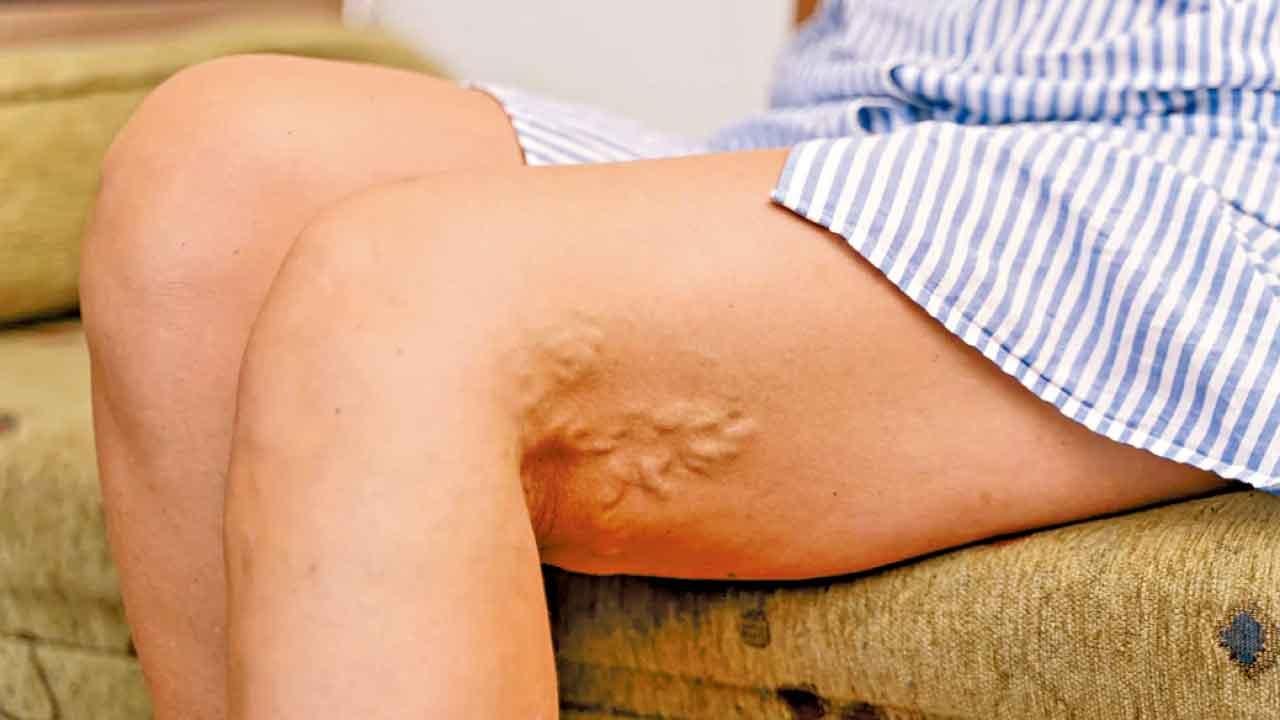 我的靜脈是否曲張？